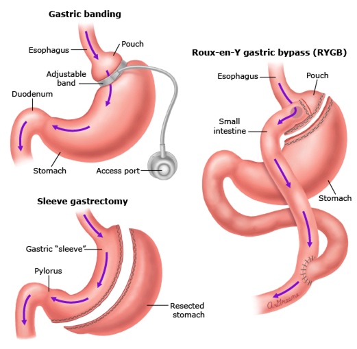 Which Surgery Gives The Best Weight Loss Centre For Bariatric Solutions 6672